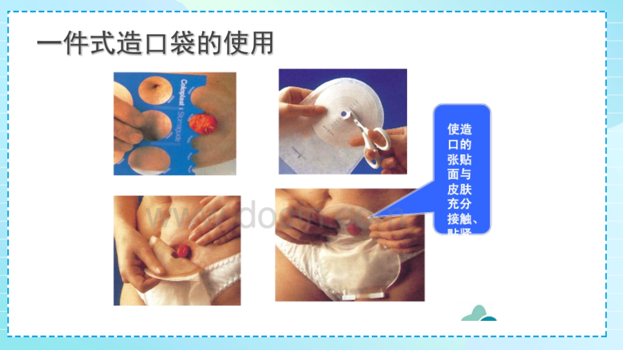 肠造口护理PPT课件17