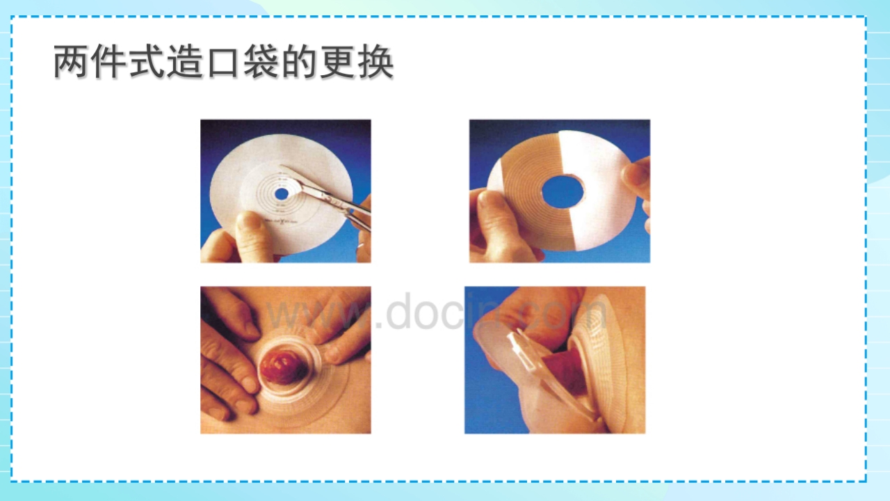 肠造口护理PPT课件18