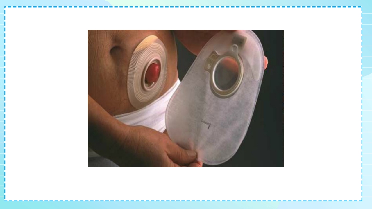 肠造口护理PPT课件19