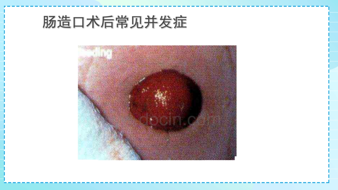 肠造口护理PPT课件25