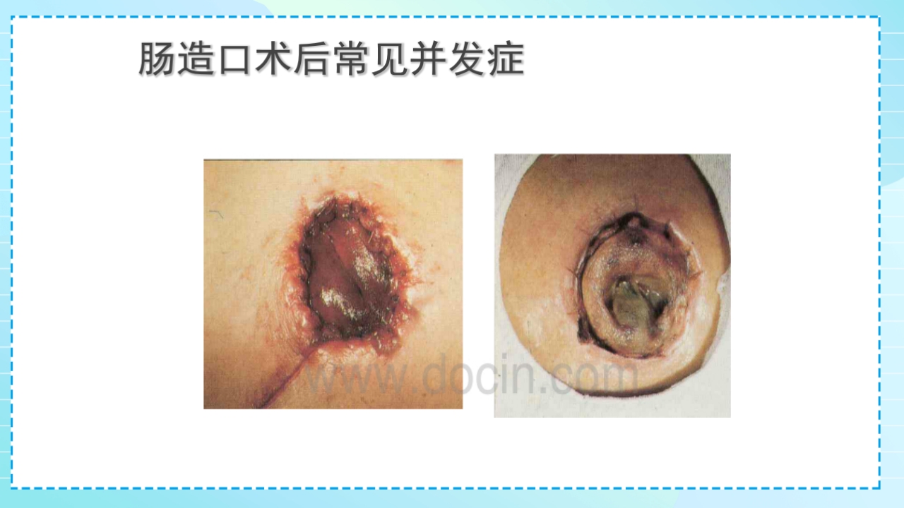 肠造口护理PPT课件27