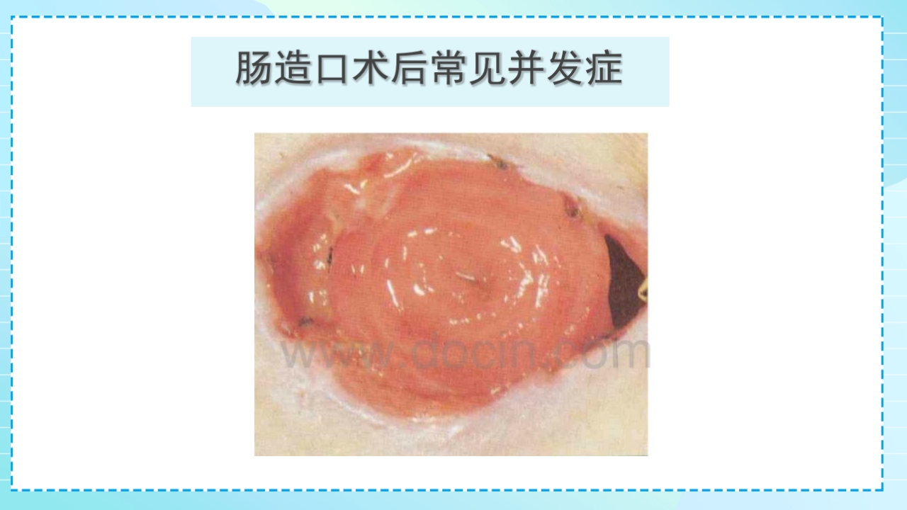 肠造口护理PPT课件32