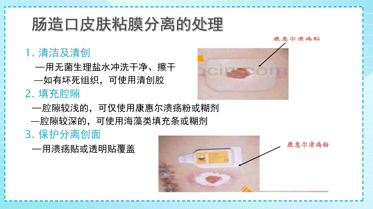 肠造口护理PPT课件33