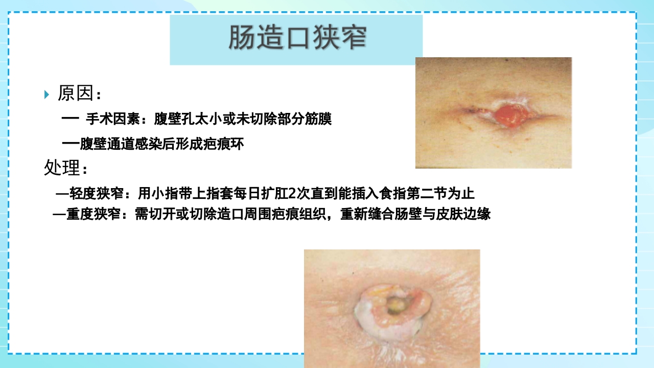 肠造口护理PPT课件34