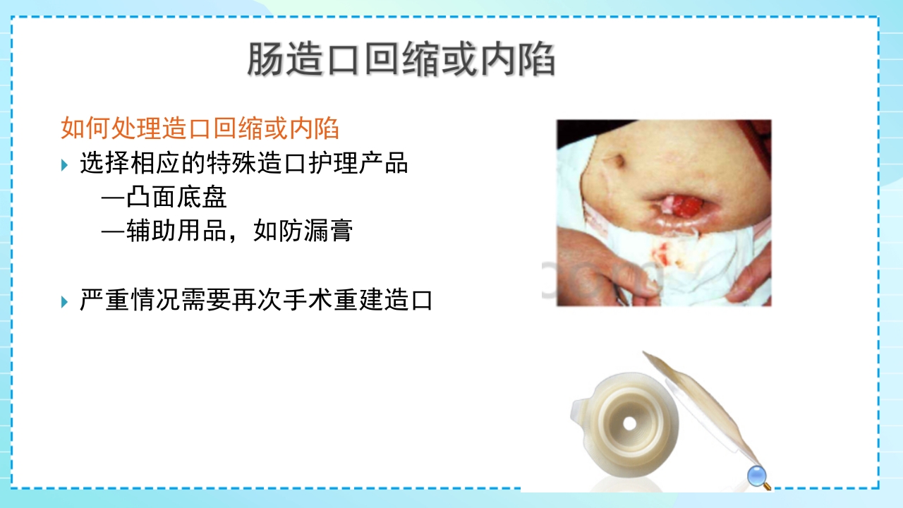 肠造口护理PPT课件35