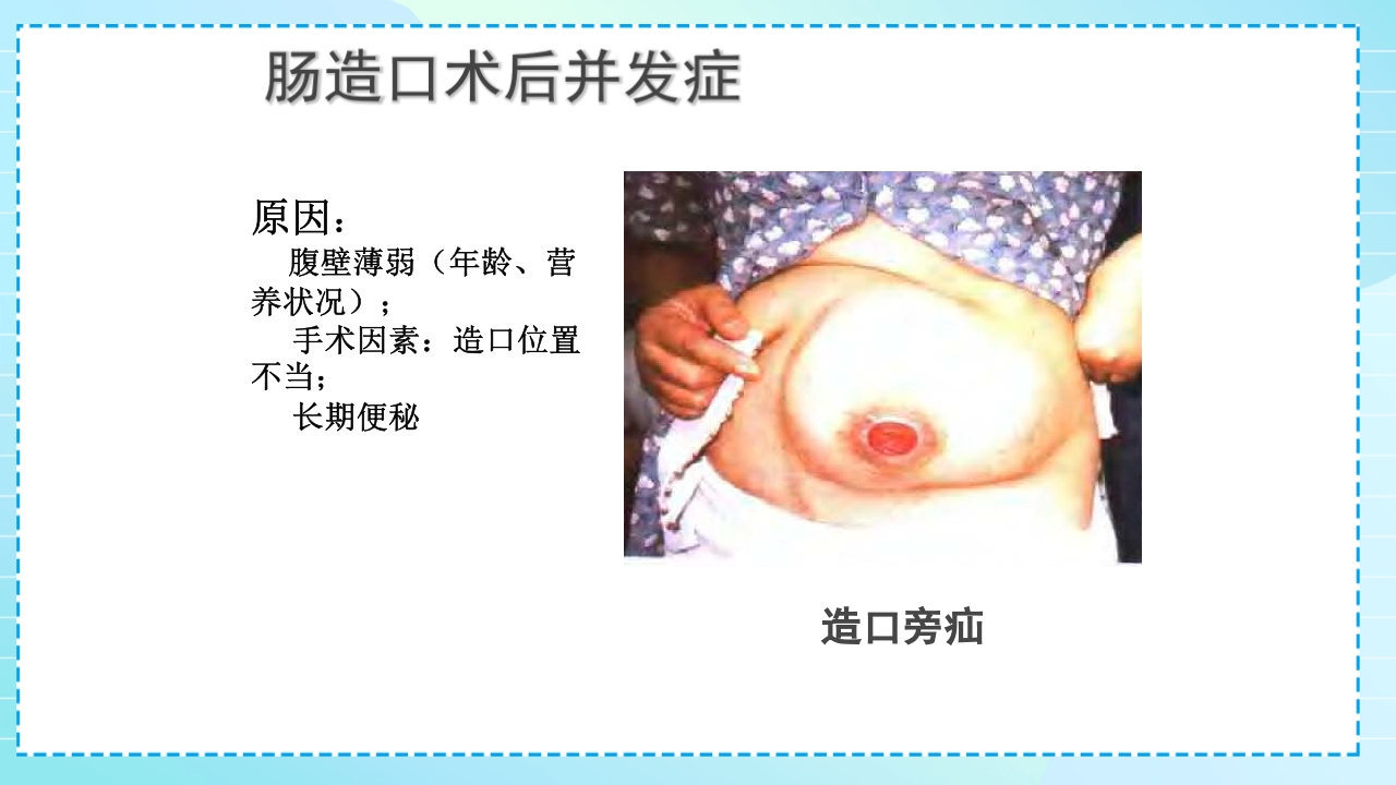 肠造口护理PPT课件38