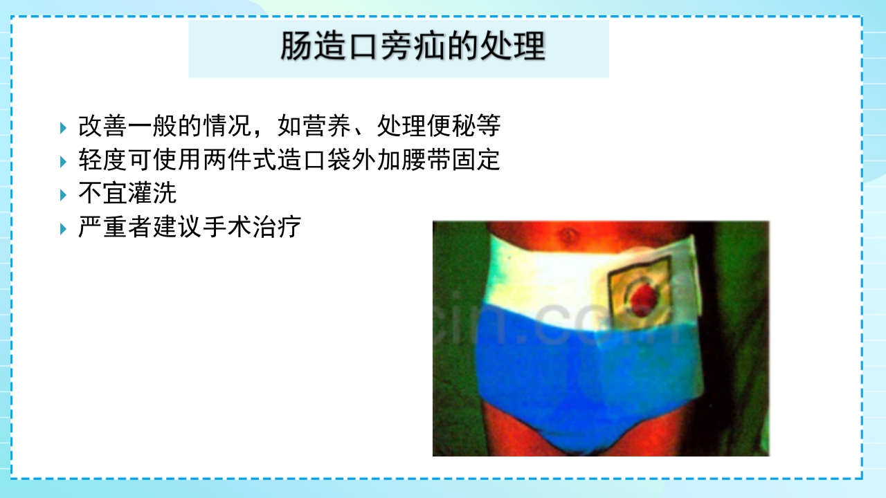 肠造口护理PPT课件39