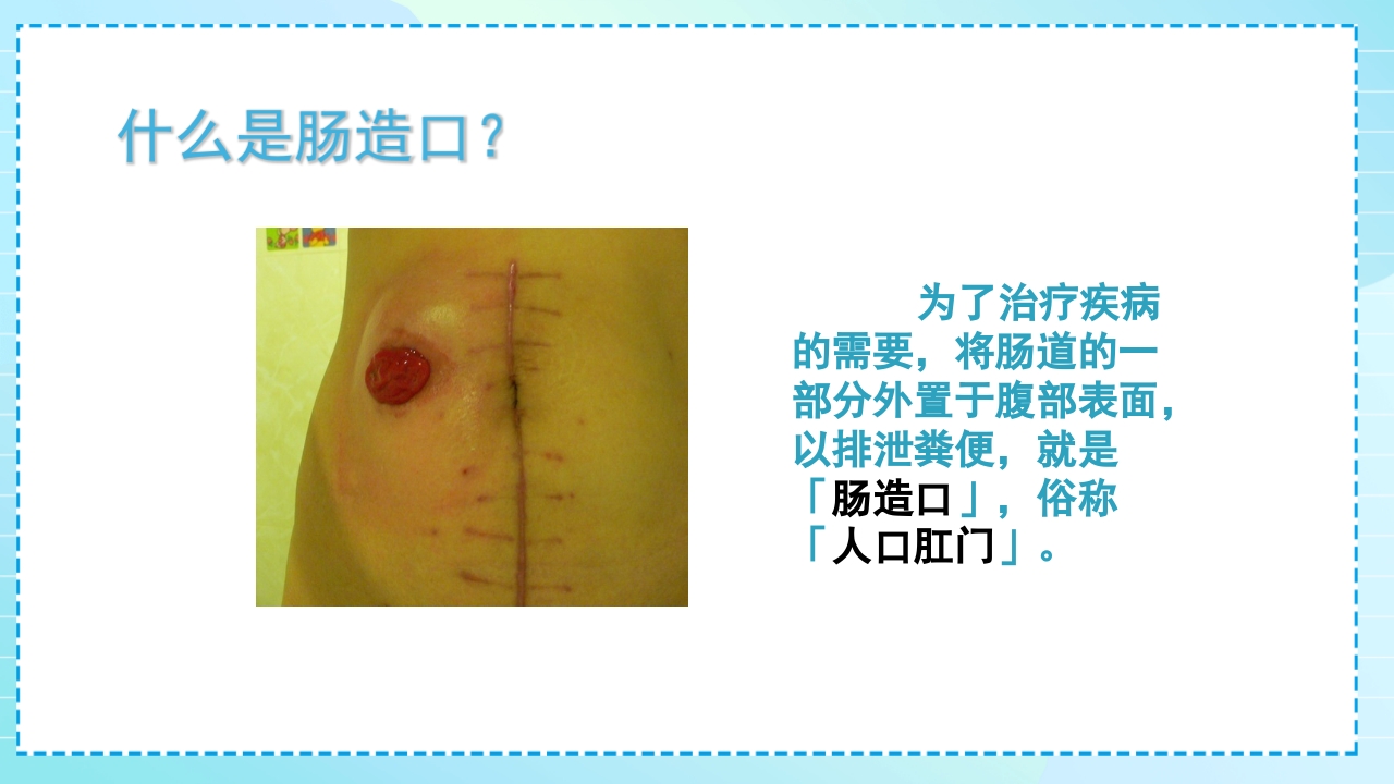 肠造口护理PPT课件3