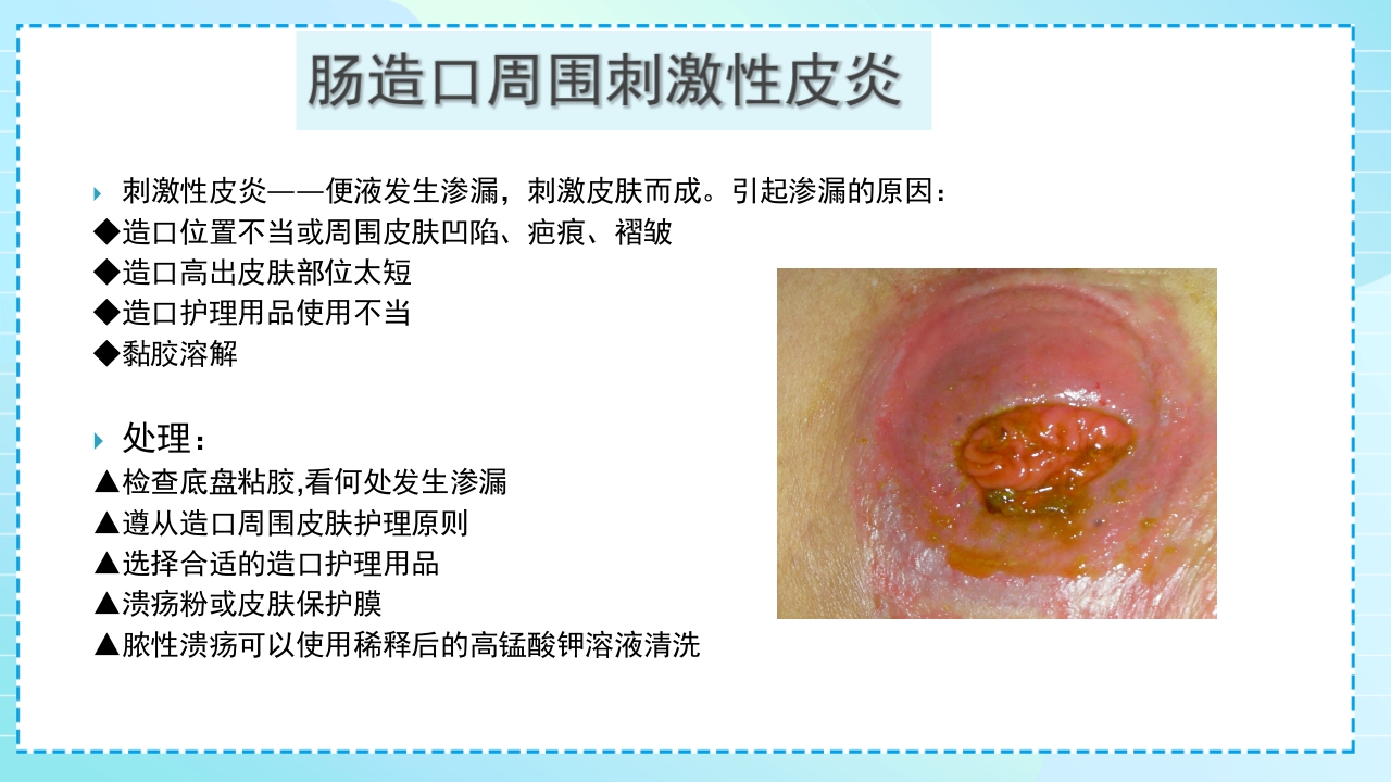 肠造口护理PPT课件41