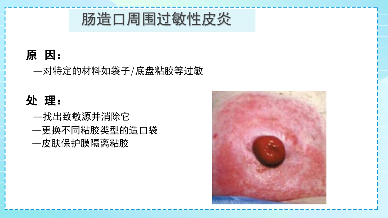 肠造口护理PPT课件42