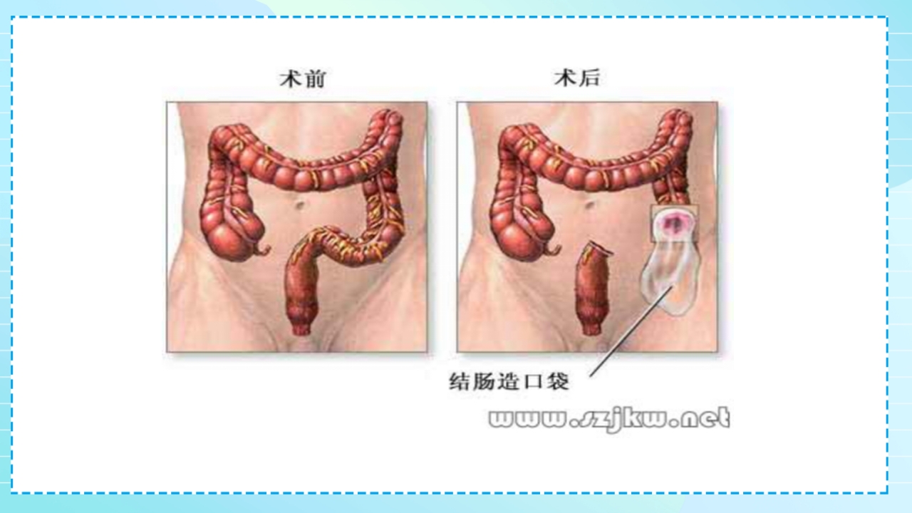 肠造口护理PPT课件6