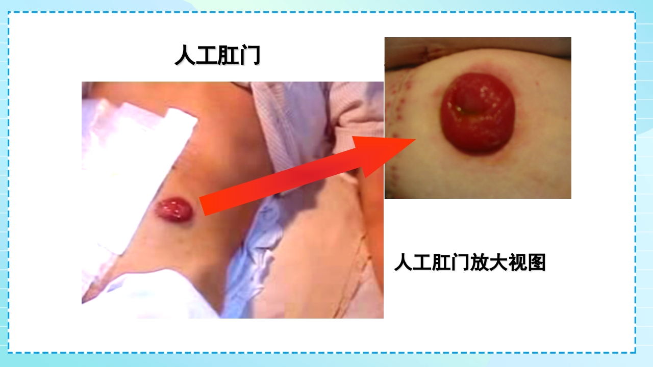肠造口护理PPT课件7