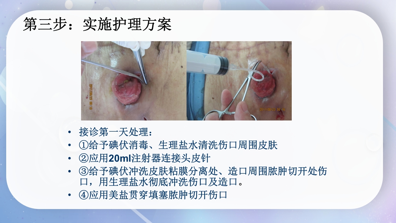 一例降结肠造口术后造口周围脓肿病人的护理PPT课件12