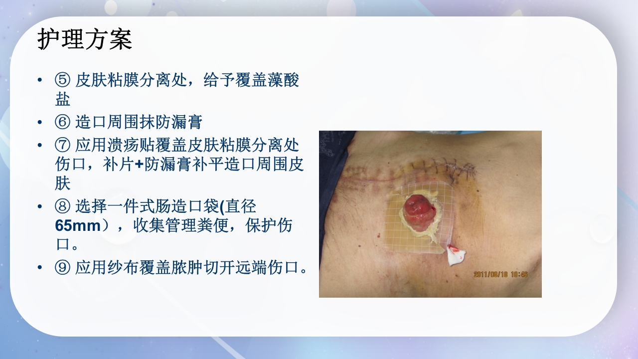 一例降结肠造口术后造口周围脓肿病人的护理PPT课件13