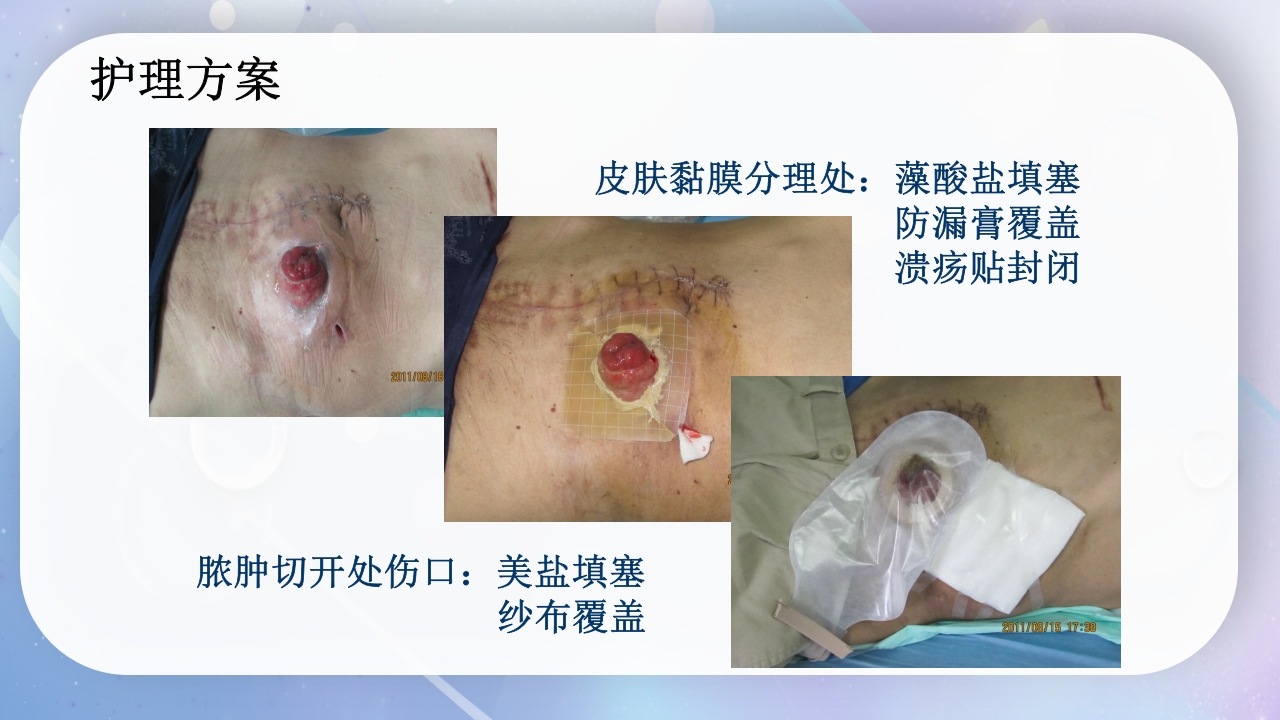 一例降结肠造口术后造口周围脓肿病人的护理PPT课件14