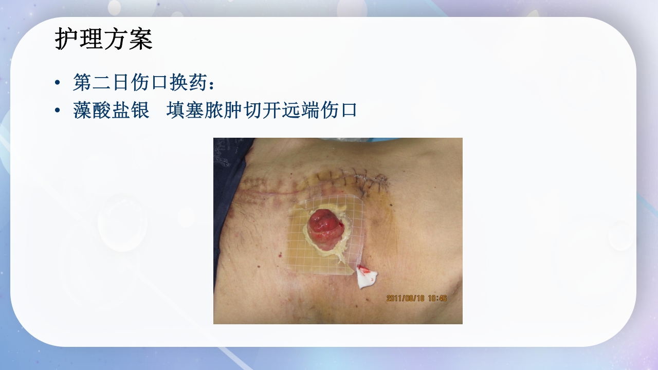一例降结肠造口术后造口周围脓肿病人的护理PPT课件15