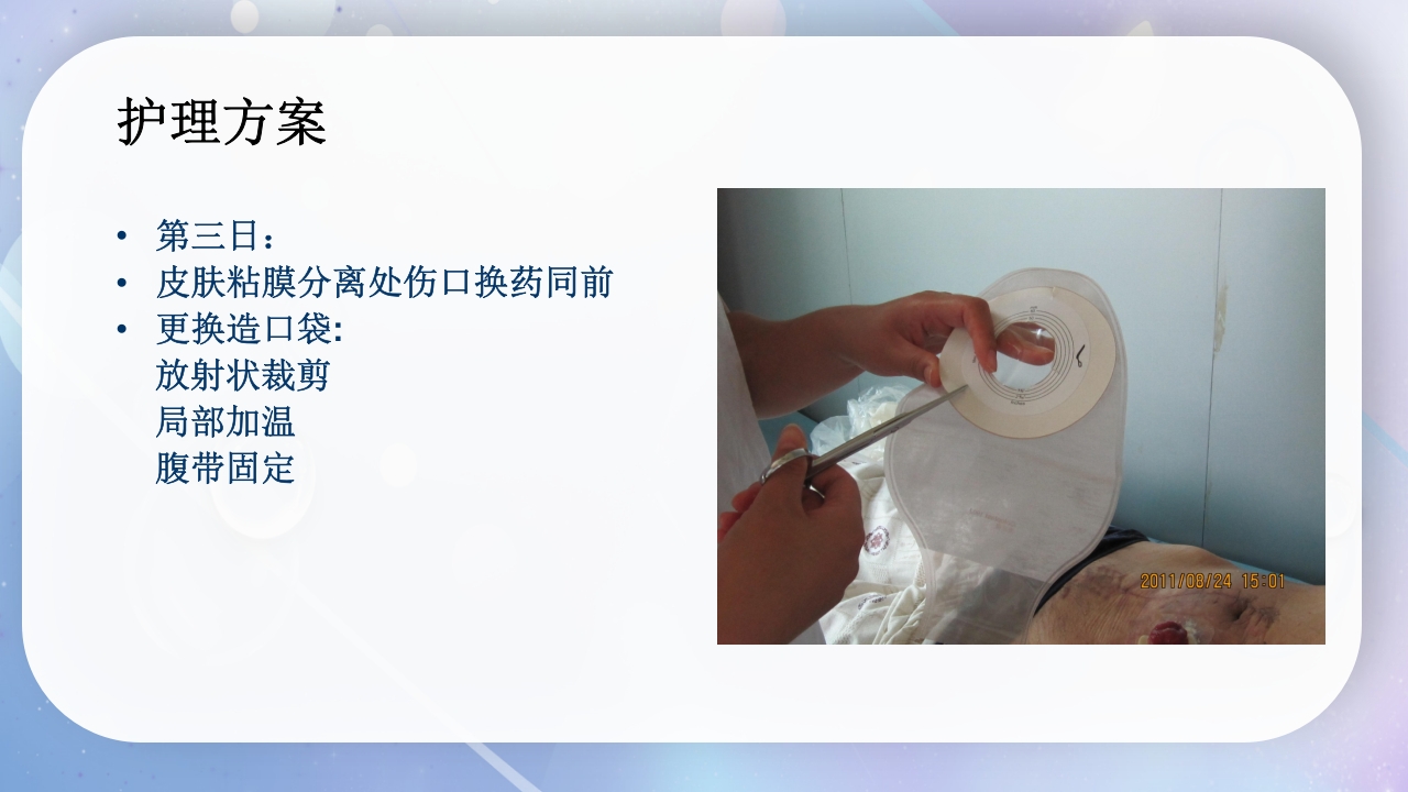 一例降结肠造口术后造口周围脓肿病人的护理PPT课件16