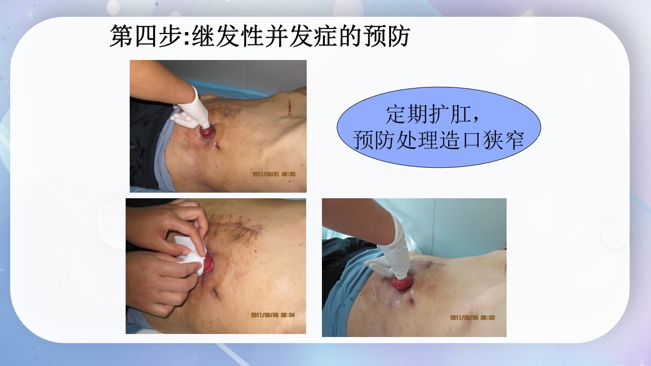 一例降结肠造口术后造口周围脓肿病人的护理PPT课件18