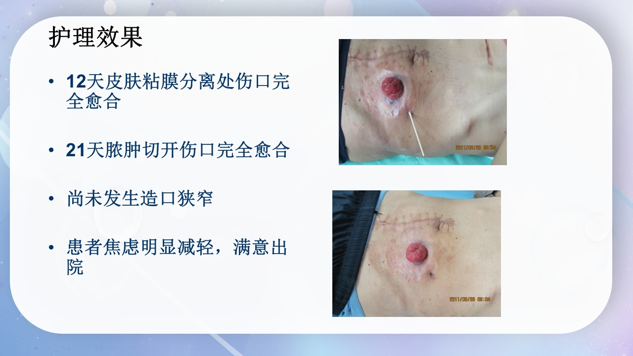 一例降结肠造口术后造口周围脓肿病人的护理PPT课件20