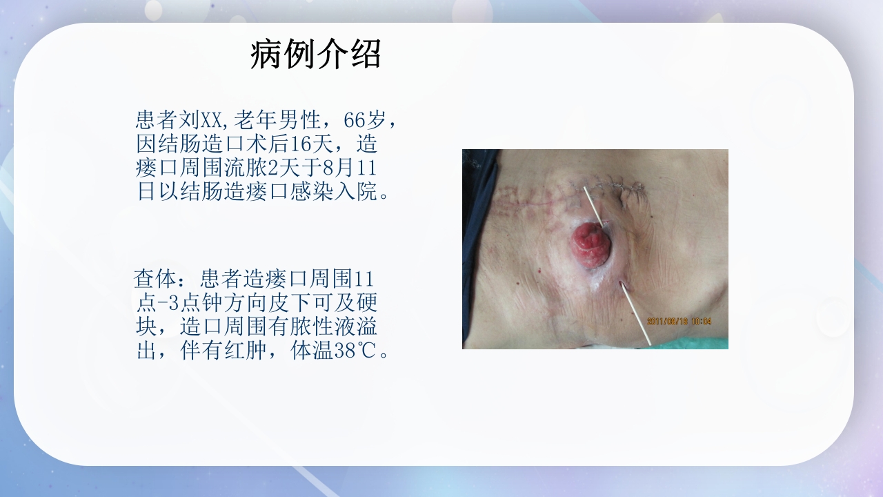 一例降结肠造口术后造口周围脓肿病人的护理PPT课件3