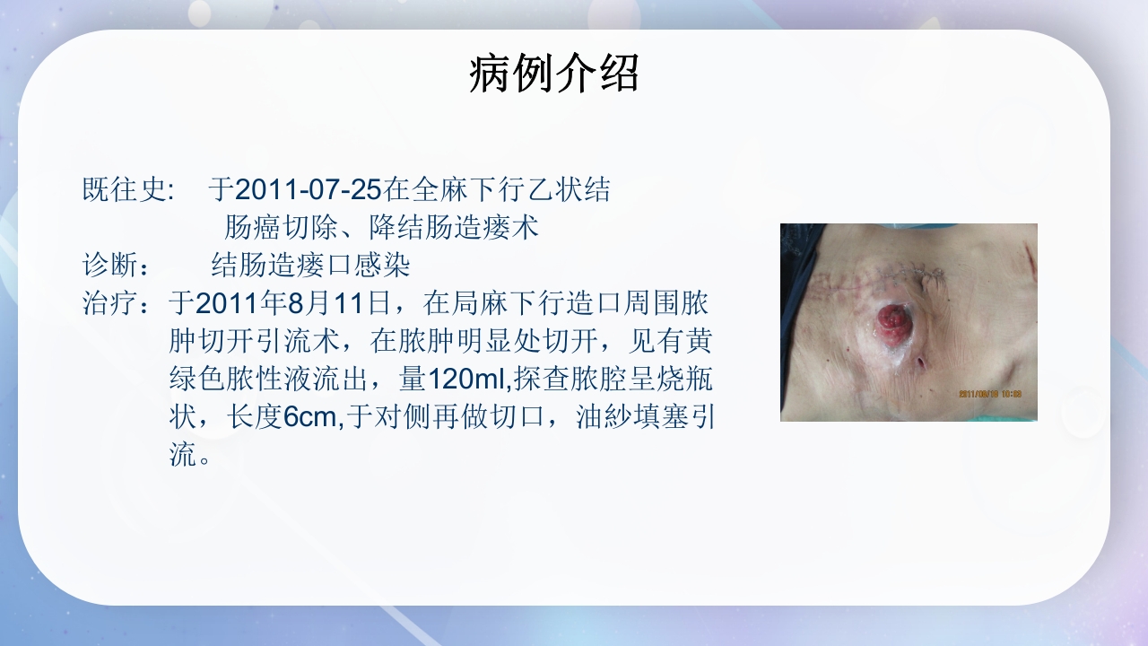 一例降结肠造口术后造口周围脓肿病人的护理PPT课件4
