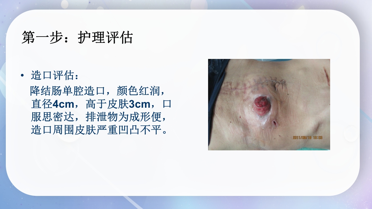 一例降结肠造口术后造口周围脓肿病人的护理PPT课件8