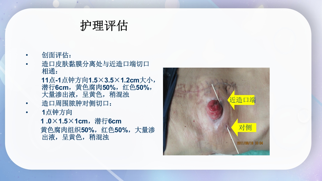 一例降结肠造口术后造口周围脓肿病人的护理PPT课件9