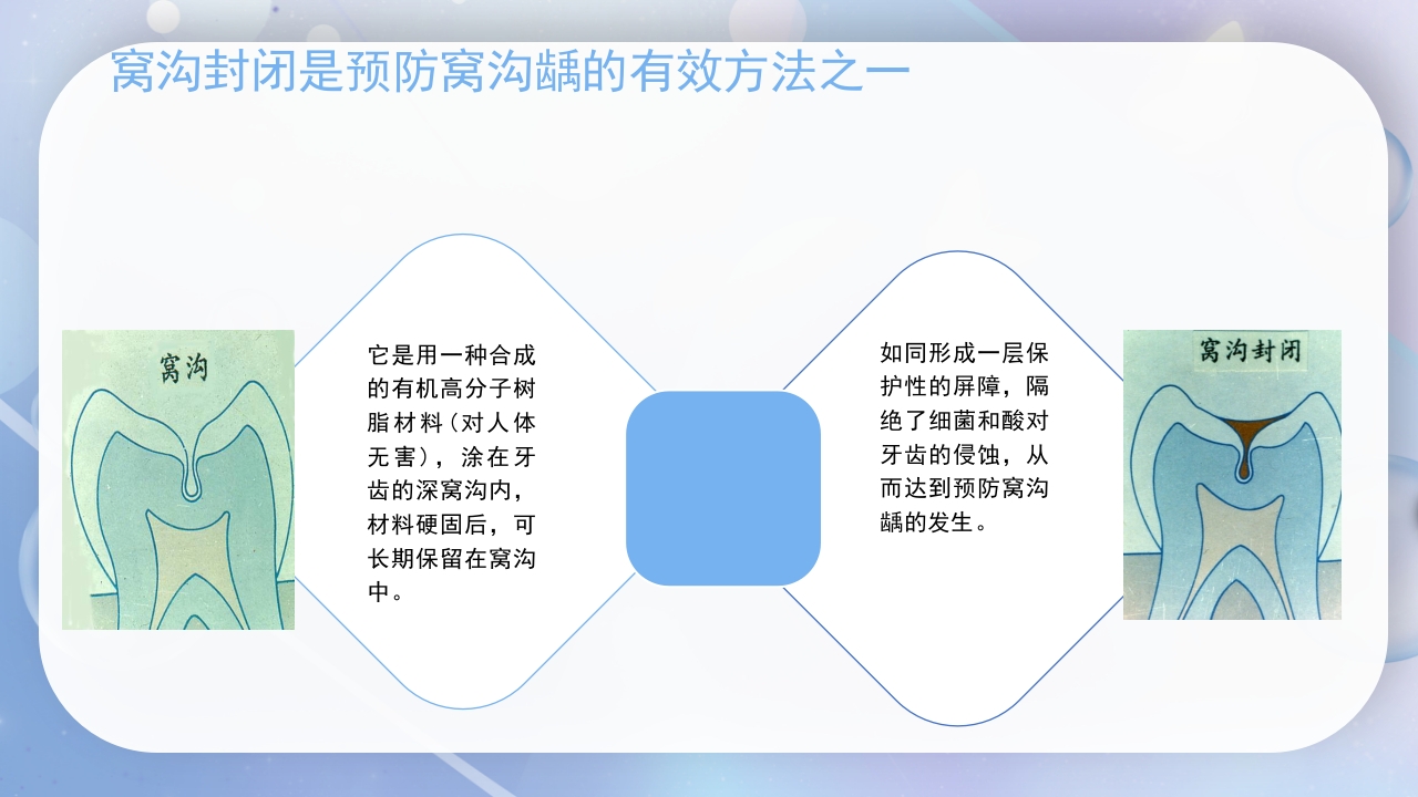 口腔健康窝沟封闭介绍PPT课件6
