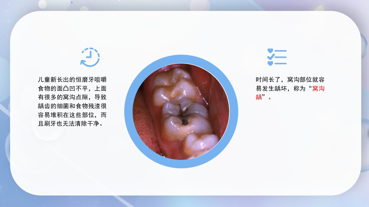 口腔健康窝沟封闭介绍PPT课件8
