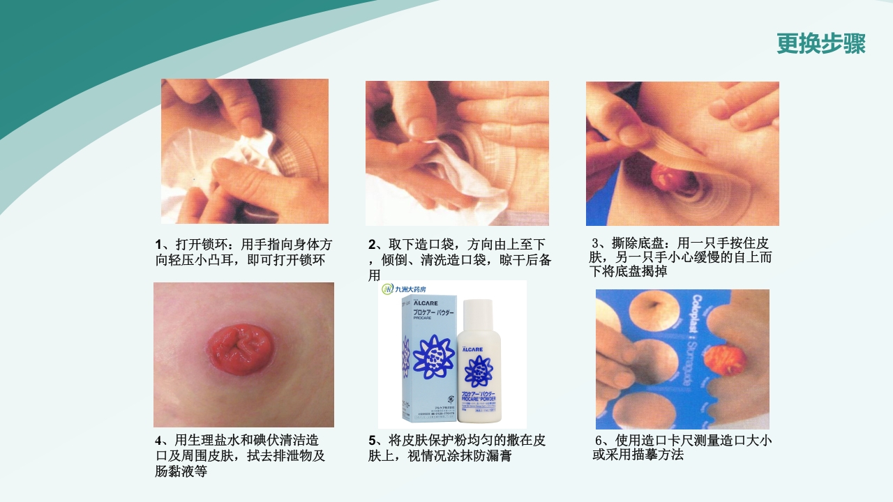 直肠造瘘术后护理PPT课件下载24