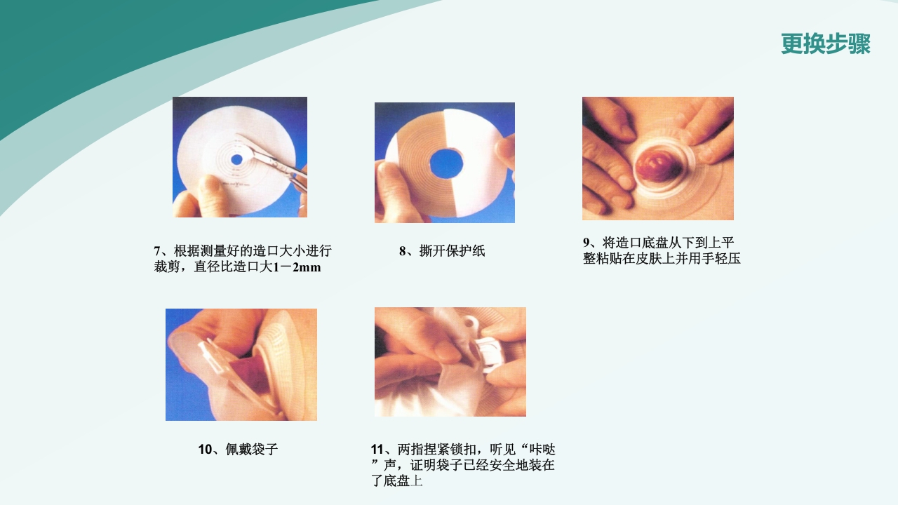 直肠造瘘术后护理PPT课件下载25