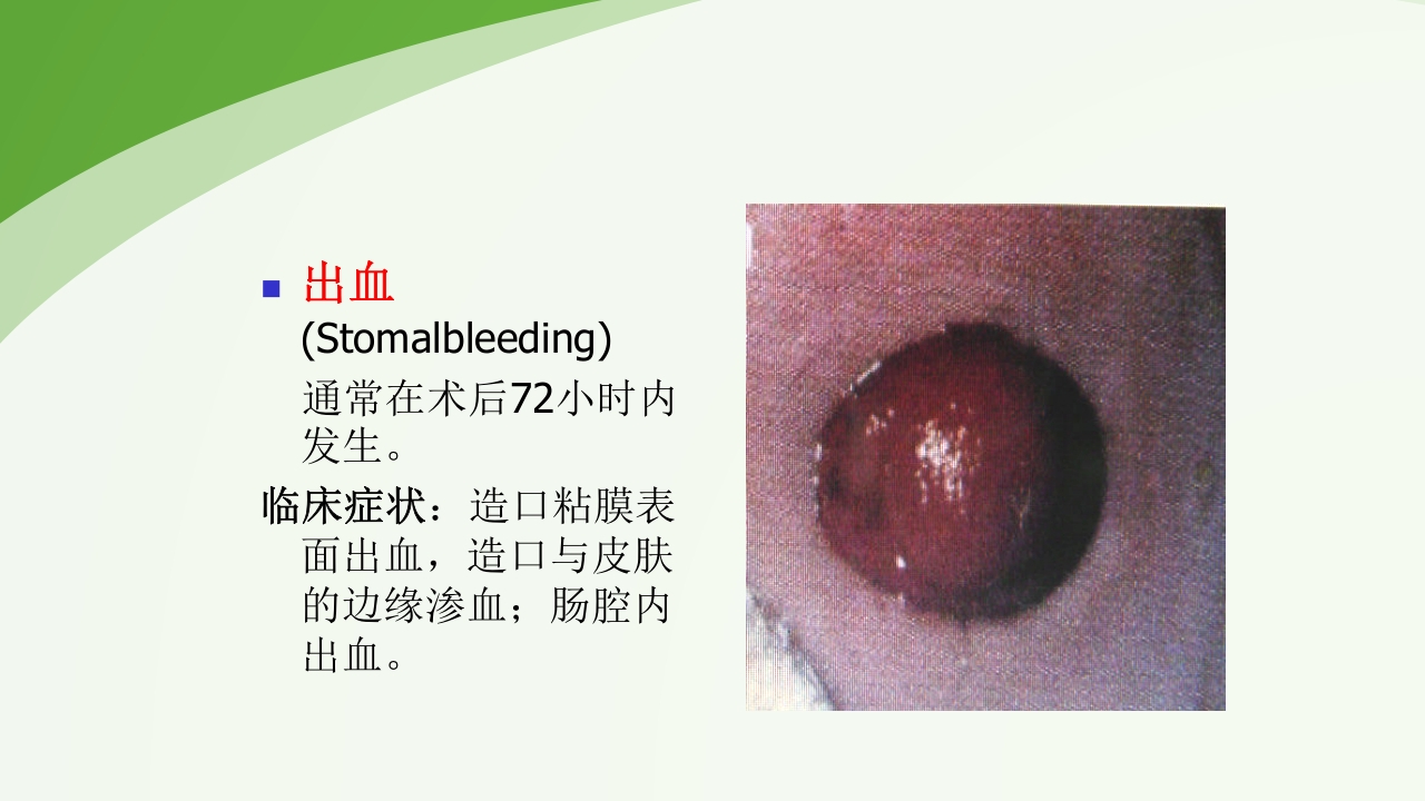 直肠造瘘术后护理PPT课件下载28