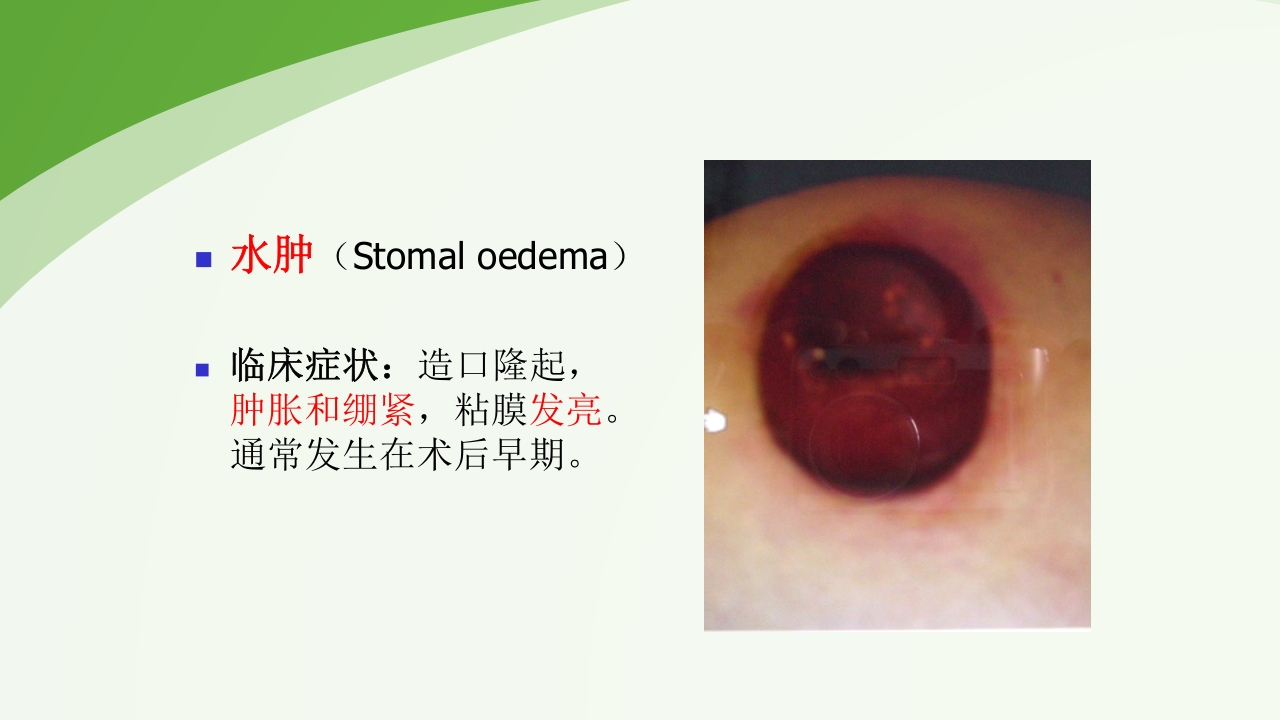 直肠造瘘术后护理PPT课件下载30