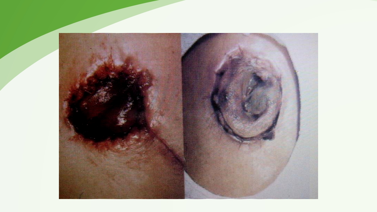 直肠造瘘术后护理PPT课件下载33