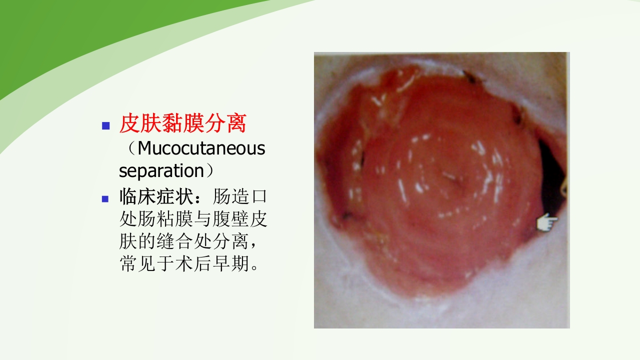 直肠造瘘术后护理PPT课件下载35