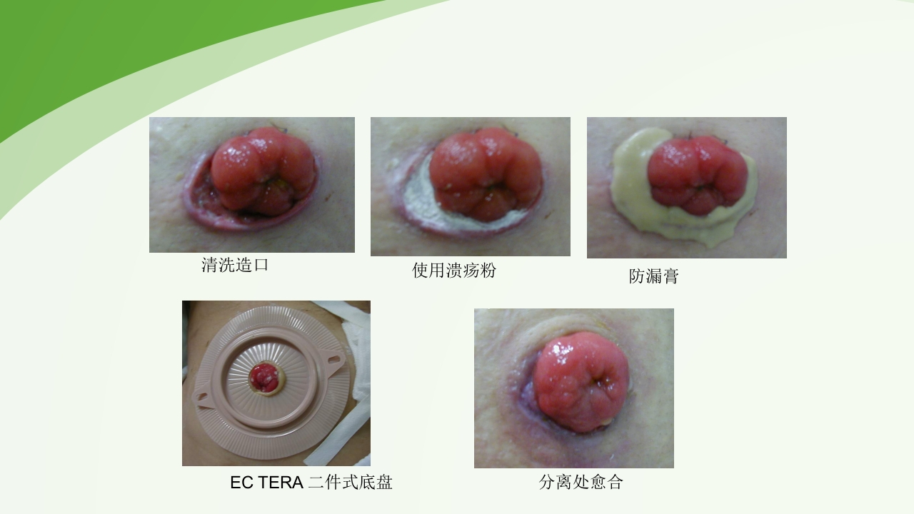 直肠造瘘术后护理PPT课件下载37