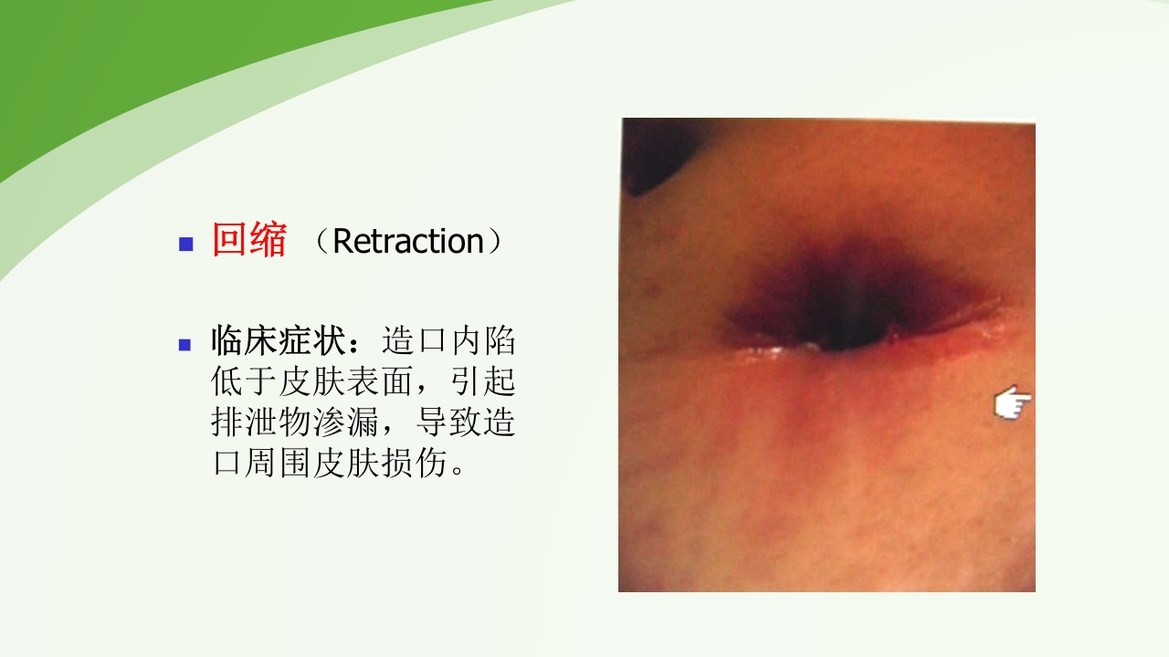 直肠造瘘术后护理PPT课件下载38