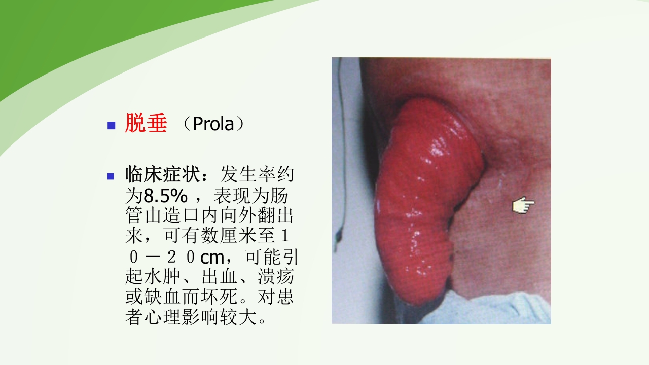 直肠造瘘术后护理PPT课件下载40