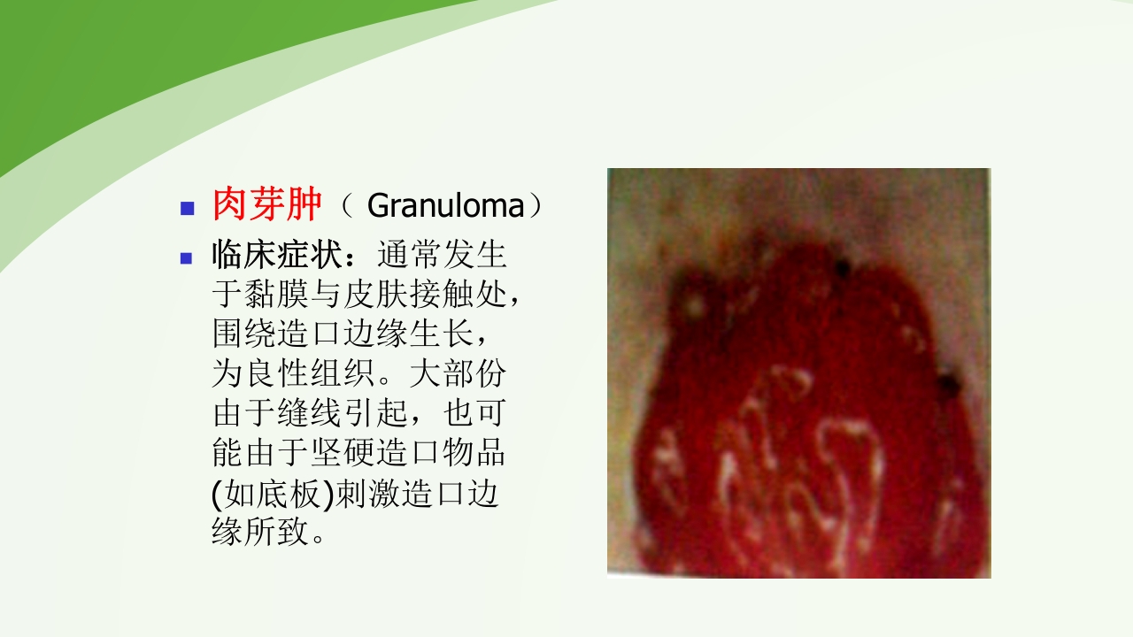直肠造瘘术后护理PPT课件下载42