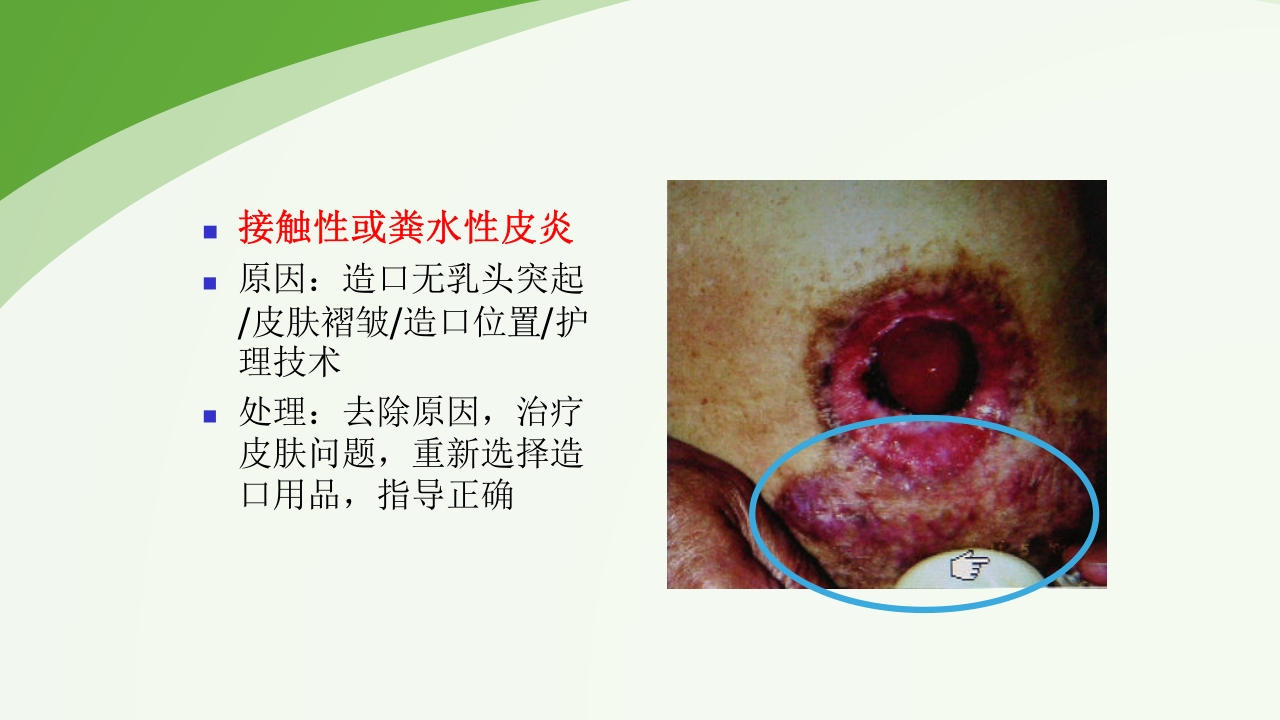 直肠造瘘术后护理PPT课件下载45