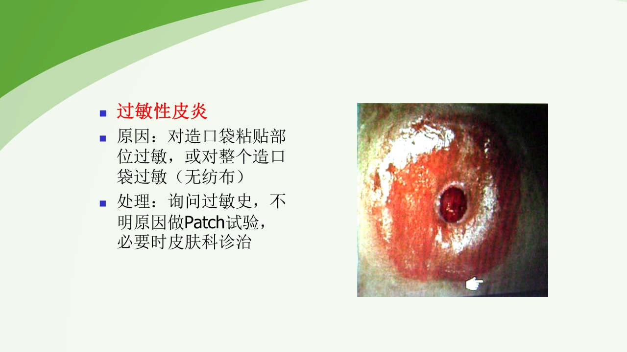 直肠造瘘术后护理PPT课件下载46