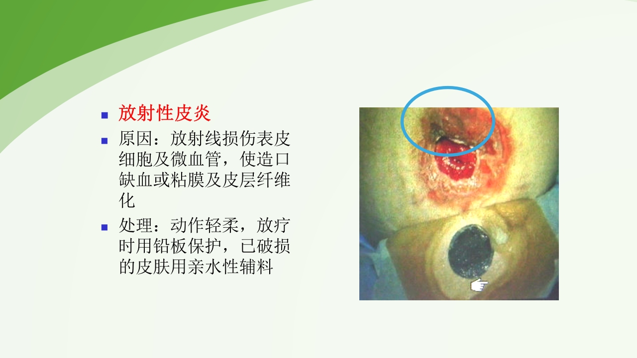 直肠造瘘术后护理PPT课件下载47