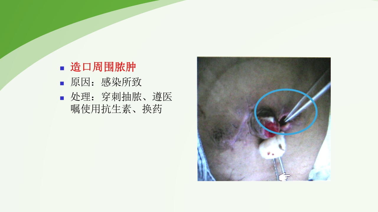 直肠造瘘术后护理PPT课件下载48