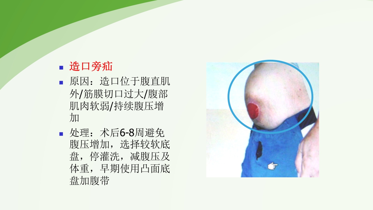 直肠造瘘术后护理PPT课件下载49