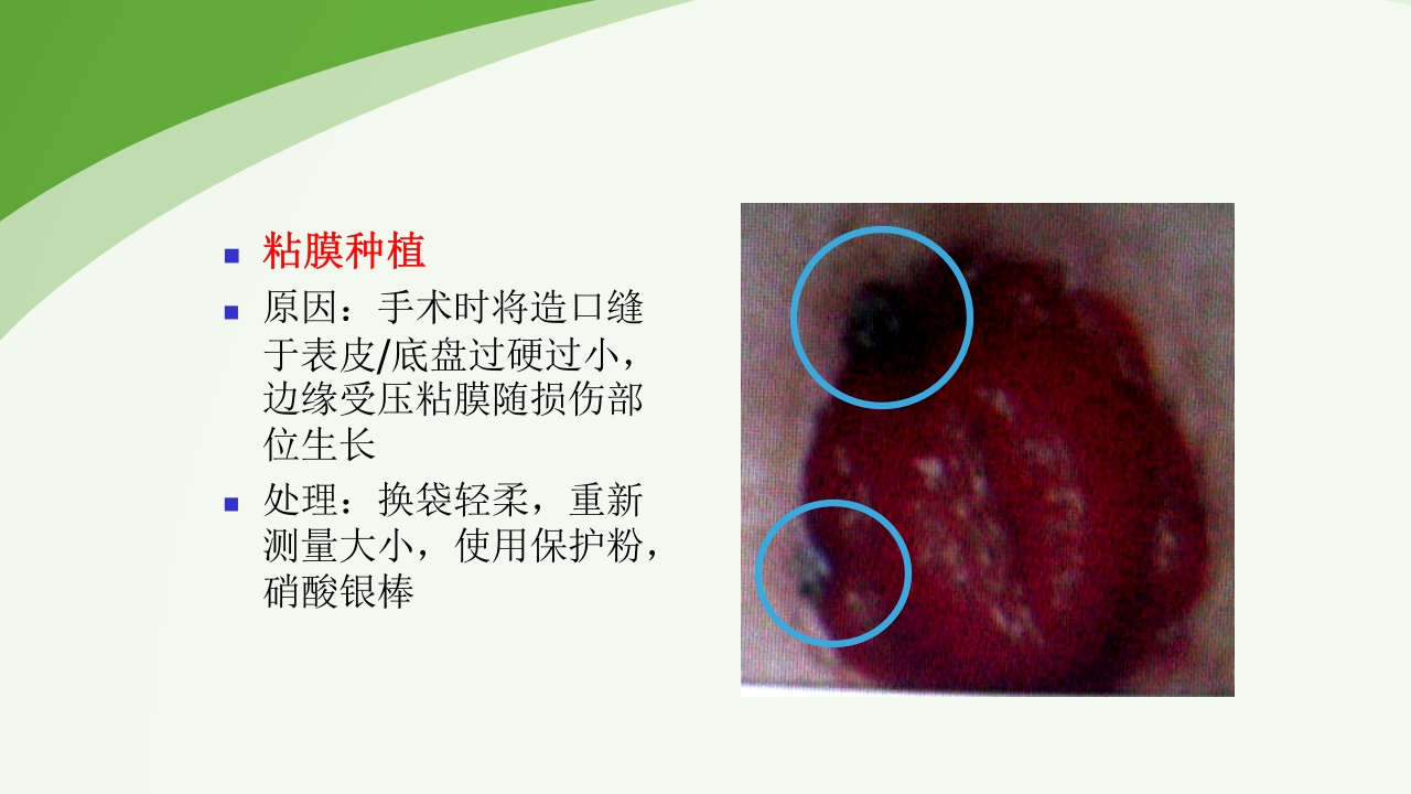 直肠造瘘术后护理PPT课件下载50