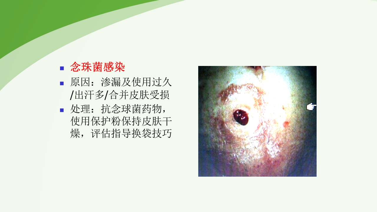 直肠造瘘术后护理PPT课件下载51