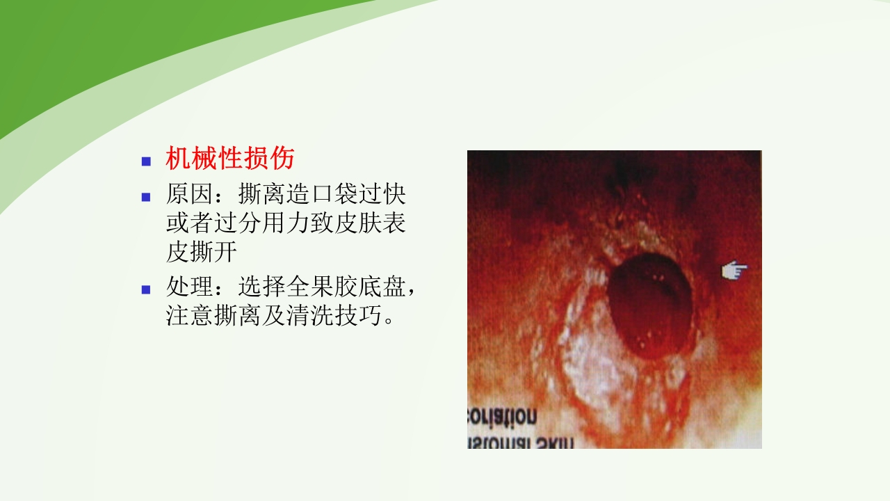 直肠造瘘术后护理PPT课件下载52