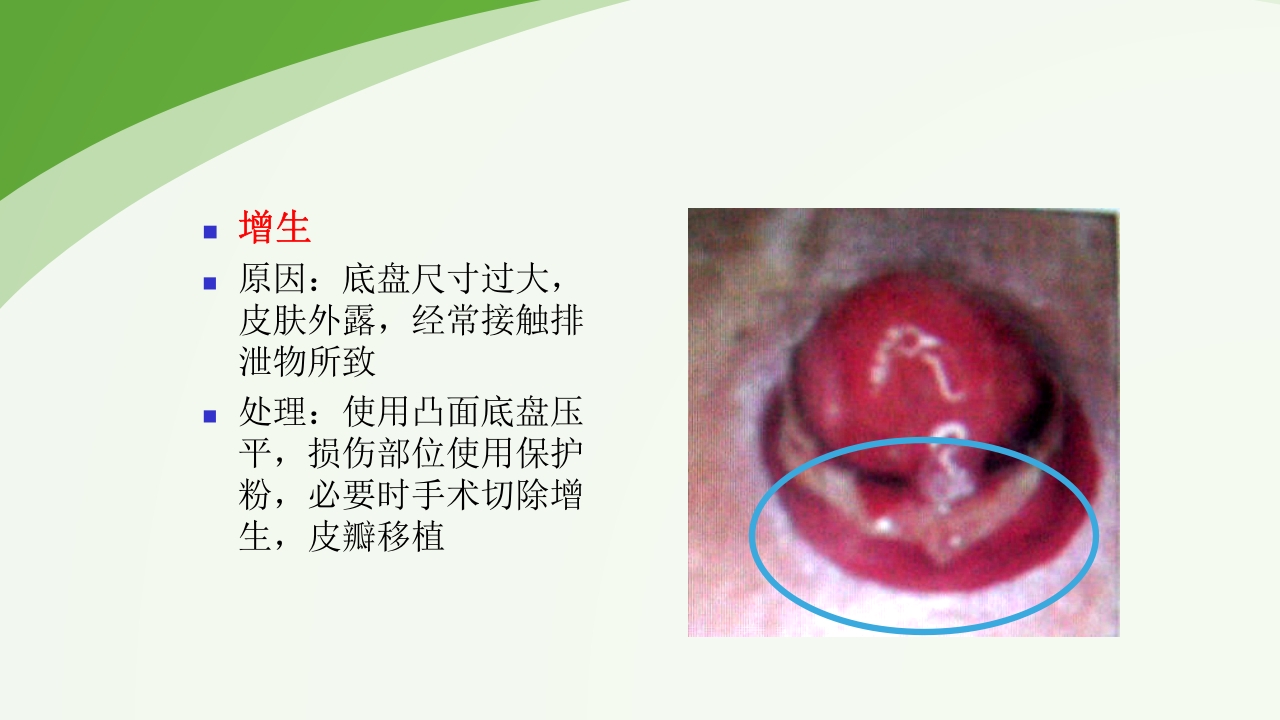 直肠造瘘术后护理PPT课件下载53