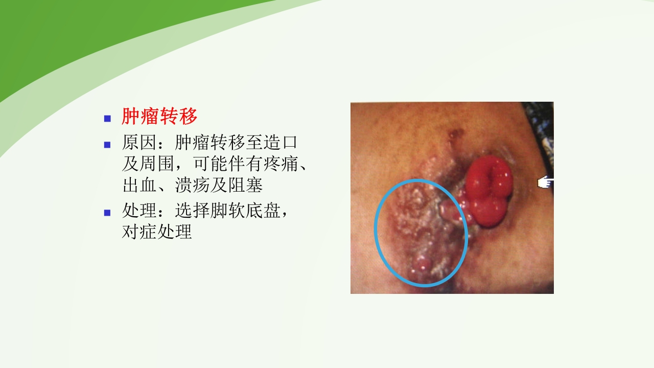 直肠造瘘术后护理PPT课件下载54
