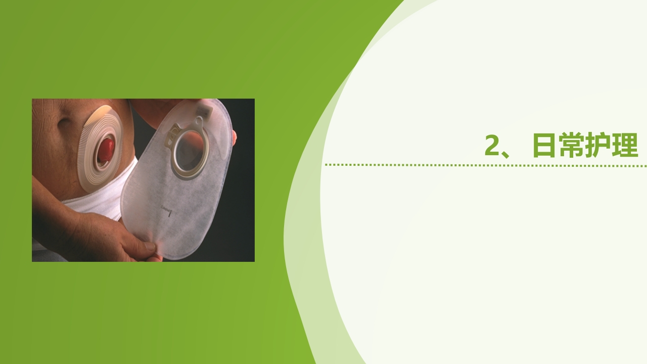 直肠造瘘术后护理PPT课件下载63